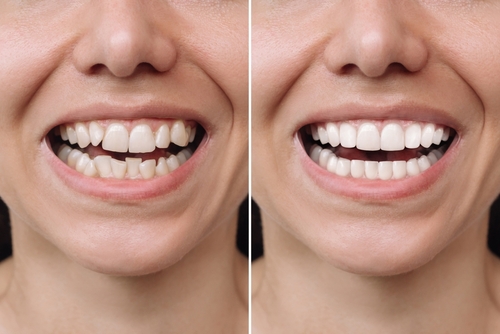 Transform Your Smile with Veneers