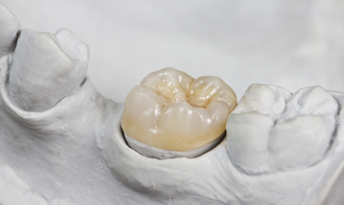 Understanding Inlays and Onlays in Dentistry