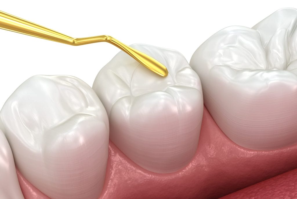 Why Porcelain Restorations Outperform Fillings
